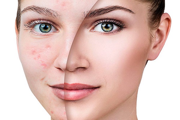 Como Prevenir E Tratar Cicatrizes De Acne Dicas Essenciais