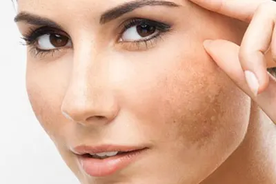 tratamento para melasma em BH