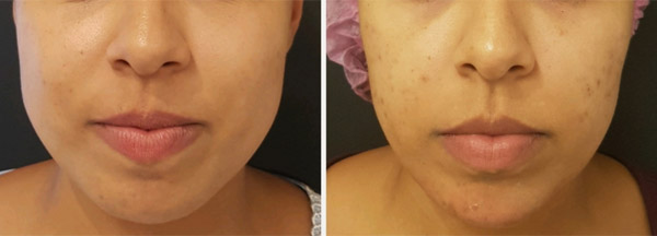 Botox no tratamento facial