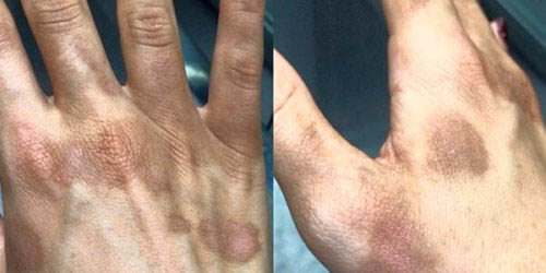 Tratamento para Manchas • Dermatologista Flávia Freitas • Belo Horizonte