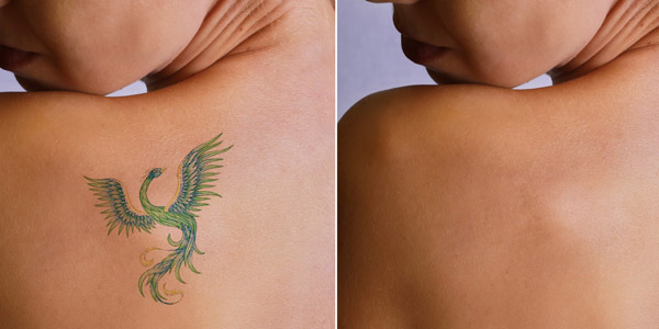 Remoção de tatuagem: antes e depois