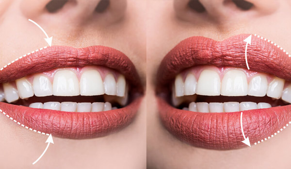 Preenchimento labial antes e depois