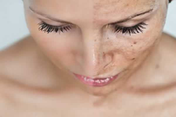Tratamento para manchas na pele