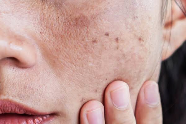 Manchas no rosto: tipos de manchas, tratamentos e cuidados
