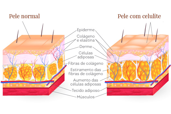 O que é a celulite