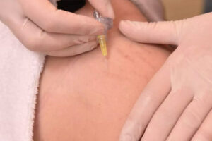 mesoterapia para estrias em BH