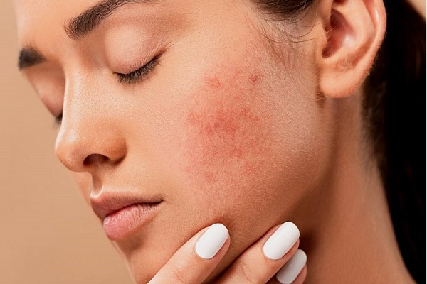 Como prevenir e tratar cicatrizes de acne: orientações essenciais!