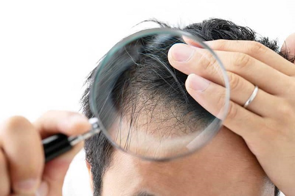 Alopecia Frontal Fibrosante: desvendando a perda de cabelo progressiva!