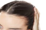 Alopecia Frontal Fibrosante: desvendando a perda de cabelo progressiva!