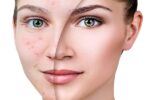 Como prevenir e tratar cicatrizes de acne: dicas essenciais!