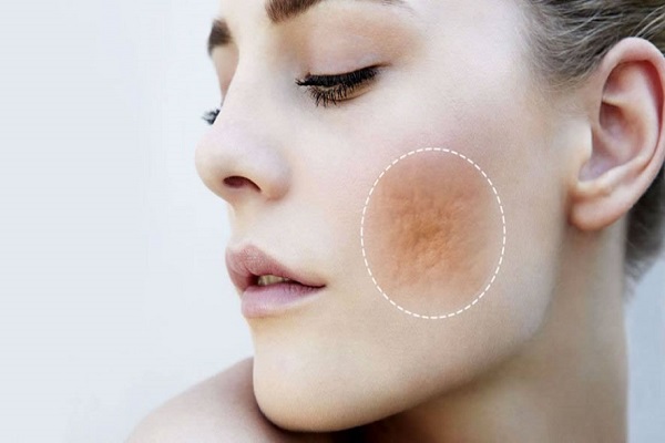 Como prevenir e tratar cicatrizes de acne: dicas essenciais!