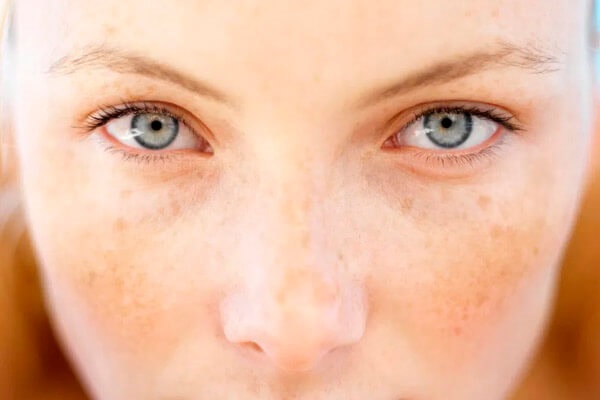 Melasma: causas, tipos e tratamento com Laser Chrome!