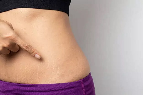 Tratamento para estrias: como remover e prevenir de forma eficiente!