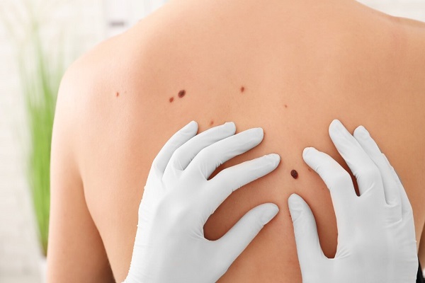 Cuidado com a pele: prevenindo o melanoma e suas complicações!