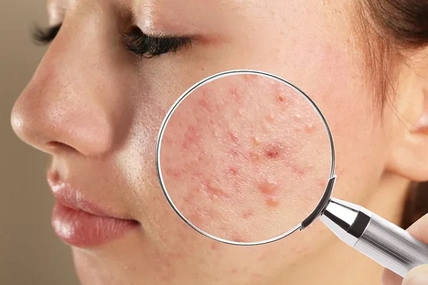 Desvendando a complexidade da acne: causas, sintomas e soluções!