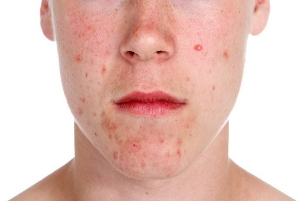 Desvendando a complexidade da acne: causas, sintomas e soluções!