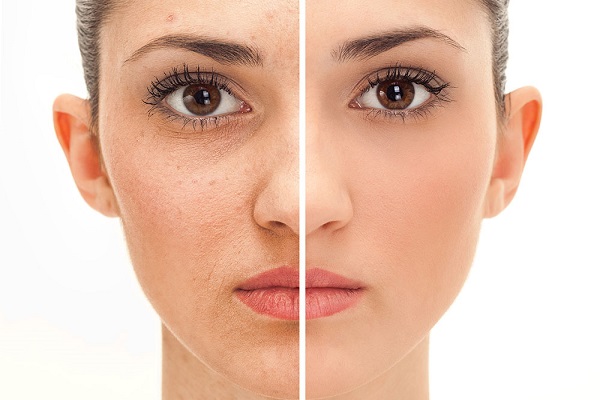 Melasma: entendendo e tratando essa complexa condição da pele!