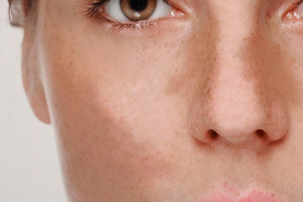 O desafio do Melasma: compreendendo suas origens e tratamentos!