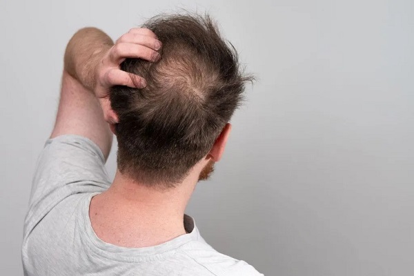 Queda de cabelo: causas e tratamentos para homens e mulheres!