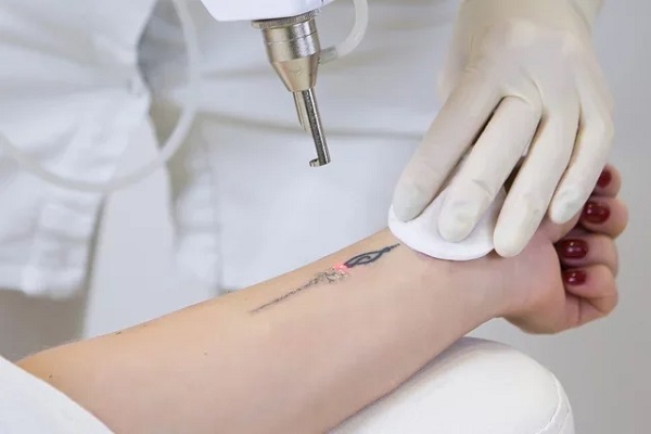 Remoção de Tatuagem a Laser: o que é e como funciona?