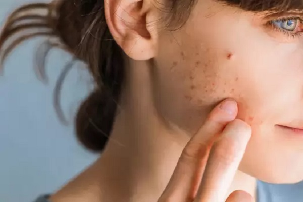 Tratando a acne: opções e abordagens para uma pele saudável!