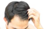 Calvície Masculina: compreendendo e enfrentando a queda de cabelo!