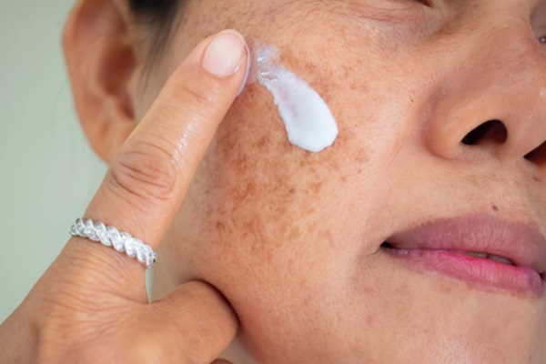 Melasma: compreendendo a complexidade e explorando opções de tratamento!