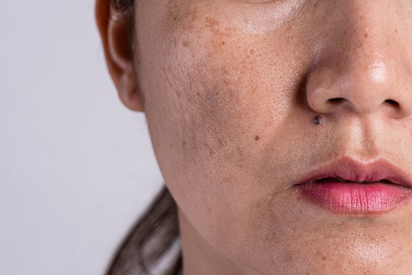 Melasma: compreendendo a complexidade e explorando opções de tratamento!