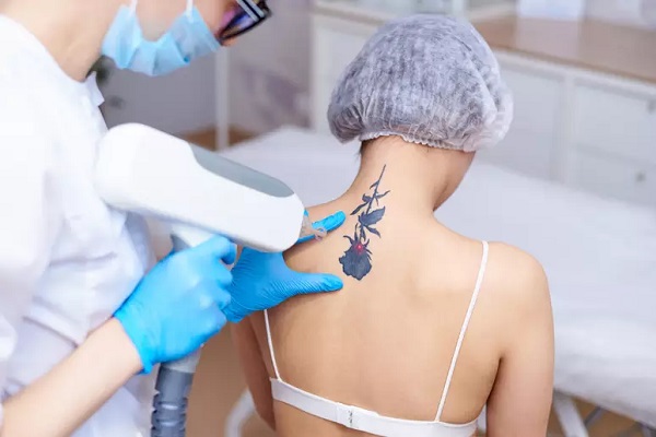 Remoção de tatuagem: saiba como o laser pode ajudar!