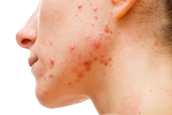 Acne: entendendo as causas, sintomas e estratégias de tratamento eficazes para uma pele saudável!