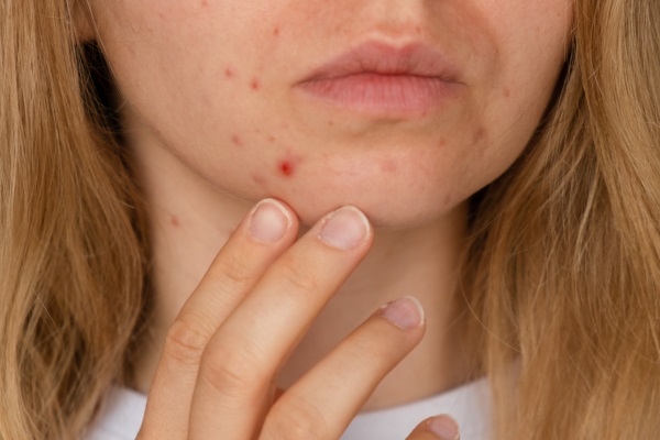 Cicatrizes de acne: cuidados para uma pele saudável!