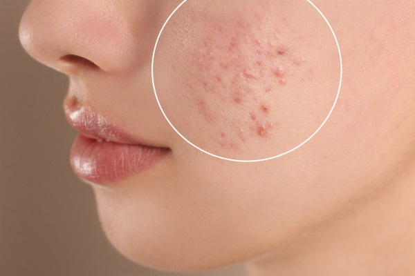 Cicatrizes de acne: cuidados para uma pele saudável!