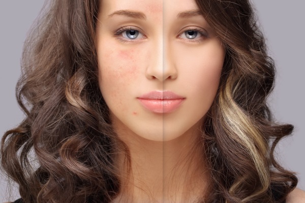 Cicatrizes de acne: explorando opções de tratamento e autocuidado!