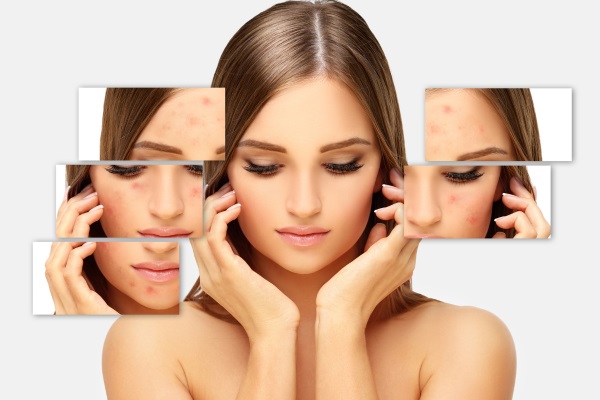 Cicatrizes de acne: explorando opções de tratamento e autocuidado!