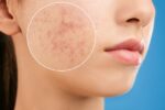 Reconstruindo a autoestima: estratégias para suavizar cicatrizes de acne!