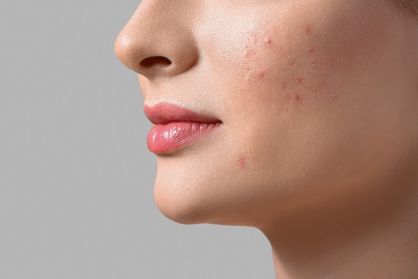 Além do Melasma: causas e soluções para as manchas na pele