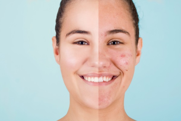 Cicatrizes de acne: abordagens modernas para redução e prevenção